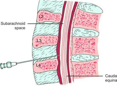 Site of lumbar puncture