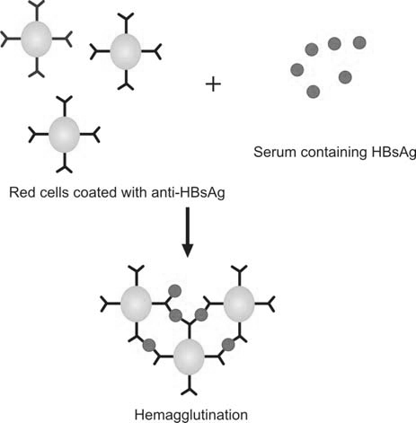 Figure 1197.2 Principle of reverse passive hemagglutination assay for HBsAg