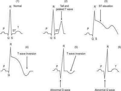 (1) Normal electrocardiogram pattern; (2) to (6): Sequential electrocardiographic changes after acute myocardial infarction. Initially, T wave becomes tall, peaked, and pointed (first few minutes) and there is ST segment elevation. T wave inversion occurs after a few hours and there is the development of an abnormal Q wave. After some duration, ST segment returns to normal and T wave becomes normal. Q wave changes, however, persist.